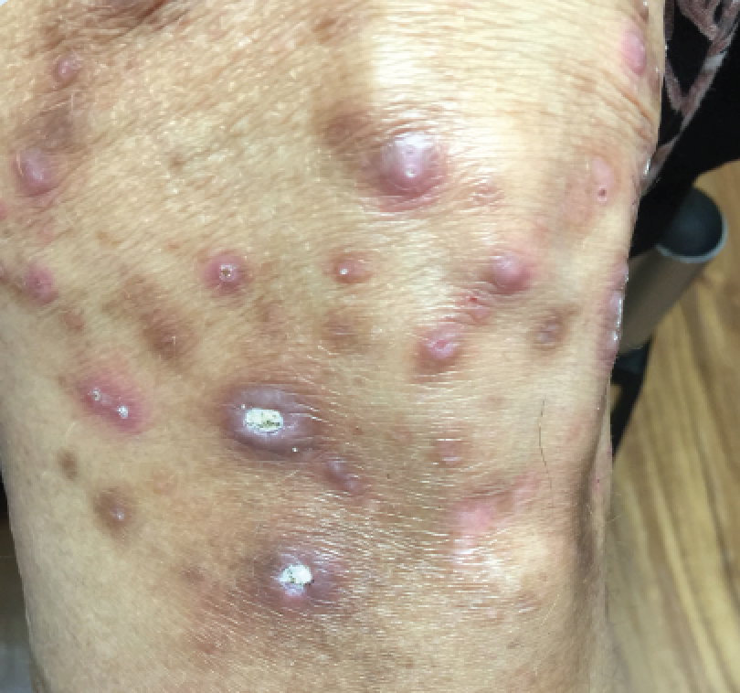 What’s Causing This Intensely Itchy Rash on a Woman’s Lower Extremities